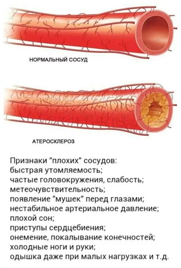 Прочистка сосудов. Чистка артерий и сосудов. Очищение кровеносных сосудов.