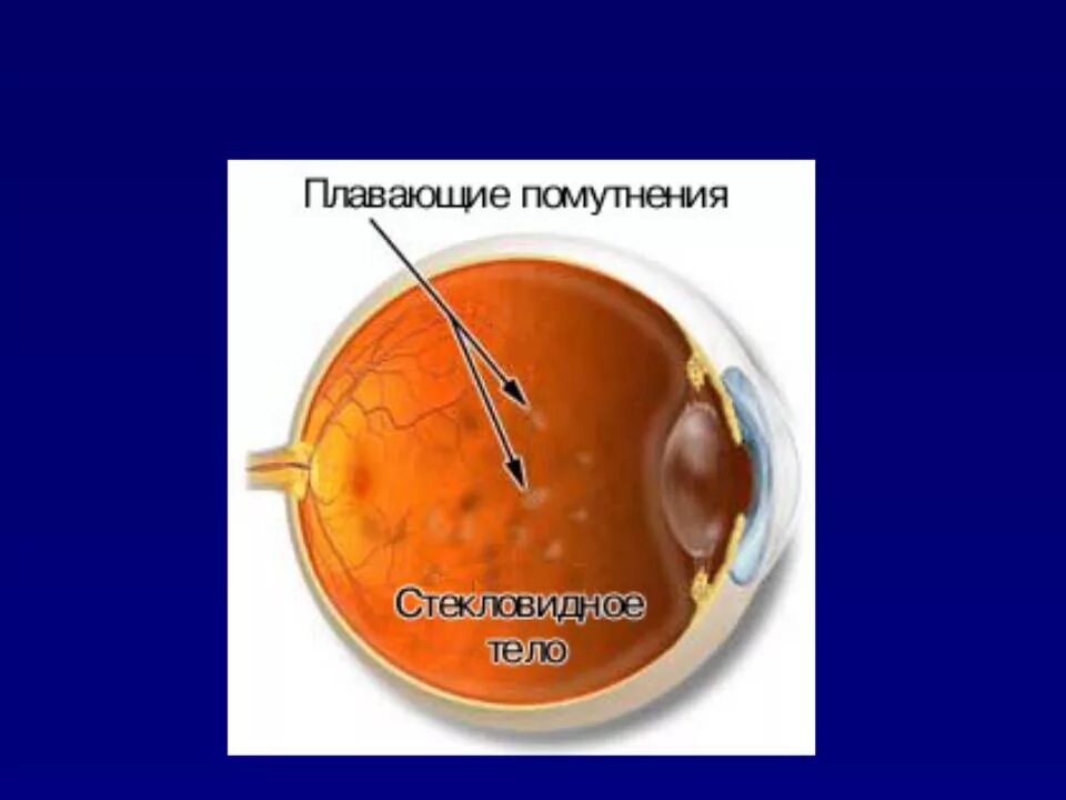 Холестероз стекловидного тела. Нитчатая деструкция стекловидного тела. Стекловидного тела пятна. Помутнения в стекловидном теле. Задняя отслойка стекловидного тела.