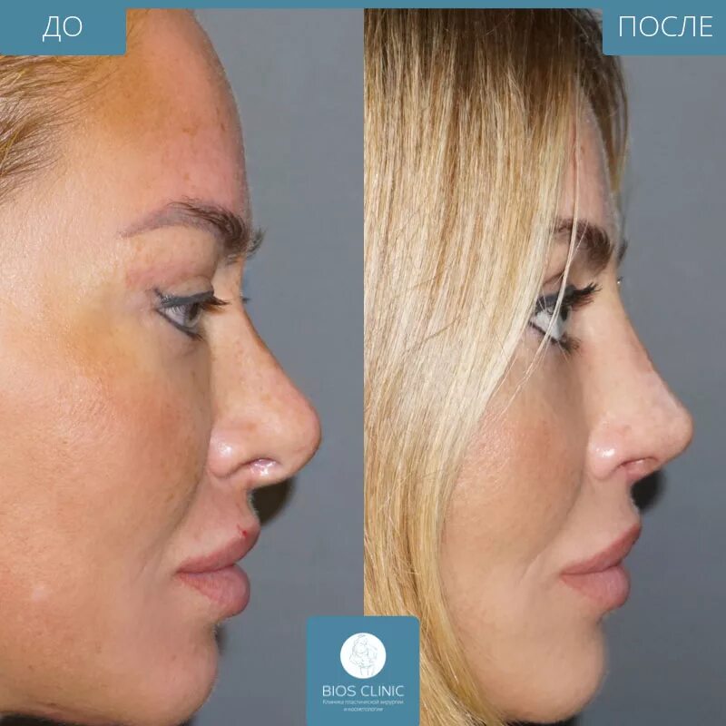 Pin by Moniii on Rhinoplasty Nose plastic surgery, Rhinoplasty nose jobs, Nose s