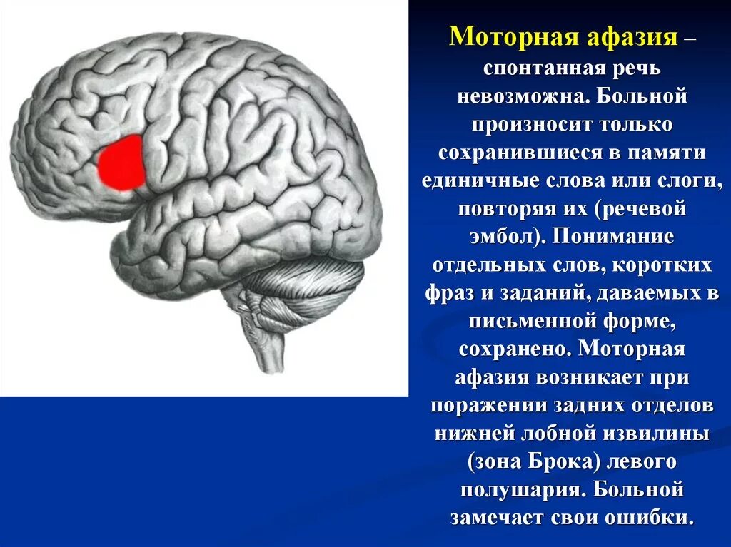 Эфферентная моторная афазия. Моторные афазии речи. Моторная афазия симптомы. Моторная афазия Брока.