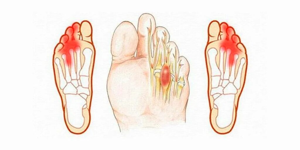 почему болит нога около пальцев