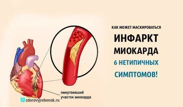 Инфаркт миокарда симптомы. Обширный инфаркт миокарда последствия. Инфаркт миокарда симптомы у женщин. Нетипичный инфаркт миокарда симптомы.