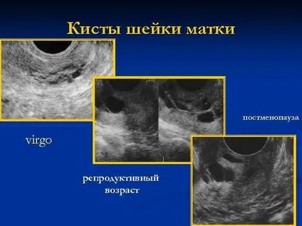Киста матки на узи как лечить