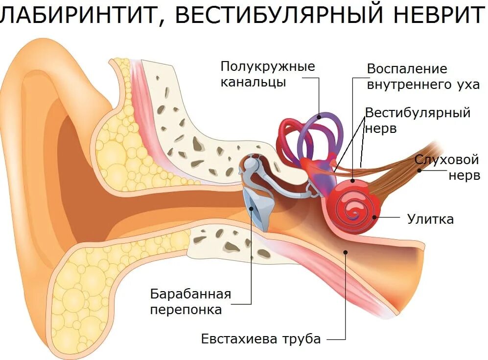 Внутреннее воспаление. Воспаление внутреннего уха (лабиринтит) возникает. тимпаногенный лабиринтит. внутренний отит (лабиринтит). лабиринтит тугоухость.