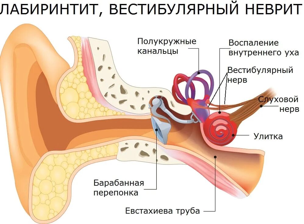 При болезни заложило уши что делать. Воспаление внутреннего уха (лабиринтит) возникает. Тимпаногенный лабиринтит. Воспаление внутреннего уха лабиринтит. Внутренний отит (лабиринтит).