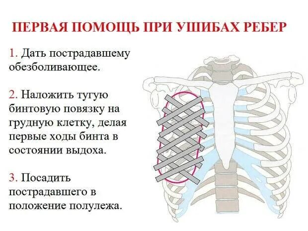 Сильно сжали грудную клетку. Признаки при переломе ребер. Признаки травмы повреждения рёбер. Перелом рёбер симптомы и первая помощь.