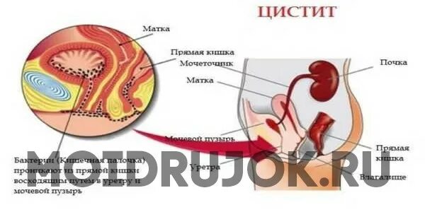 Цистит половым путем от мужчины к женщине. Поистконотальеый цестиь.