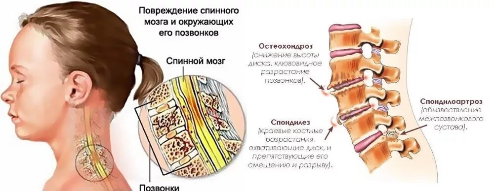 Деформирующий спондилез с3-с4. Спондилез с4-с5 шейного отдела позвоночника. Спондилез l2 l3 1ст. Полисегментарный спондилез. Спондилез l3