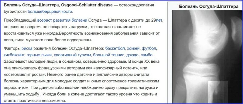 Болезнь осгуда мкб. Осгуд шляттера болезнь рентген. синдром осгуд шляттера узи. болезнь осгуда шлаттера описание рентгенограммы. исход болезни осгуда шлаттера.