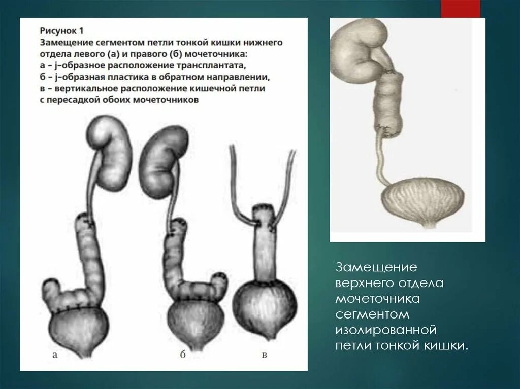 Устьевой сегмент левого мочеточника. Н жней трети мочеточника. Замещение мочеточника сегментом тонкой кишки. Сегменты мочеточника рентген. Обоих мочеточников