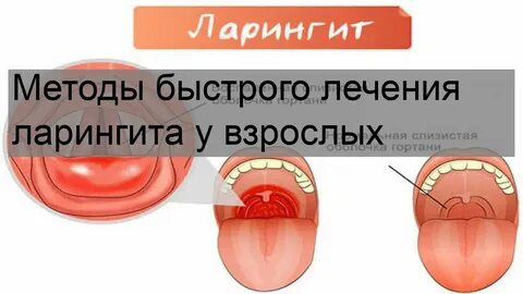 Лечение ларингита у взрослых отзывы