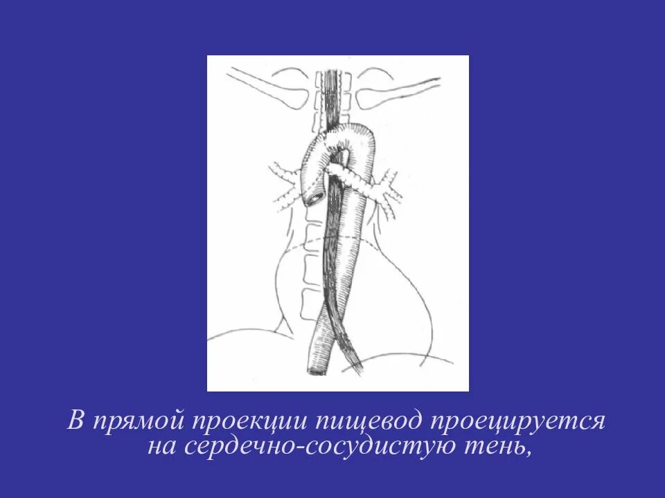 Лучевая пищевода. Проекция пищевода. Прямая проекция пищевода. Пищевод в прямой проекции. Рентген пищевода в прямой проекции.