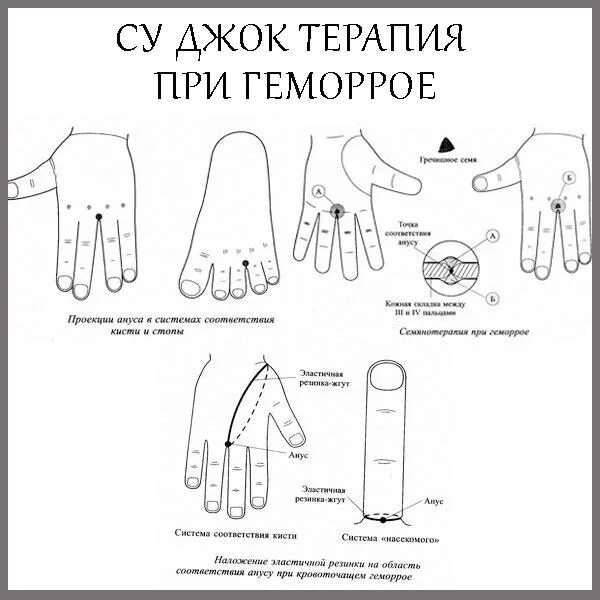 Точки воздействия Су Джок. Су Джок терапия точки. Семянотерапия Су Джок для кишечника. Су Джок система соответствия кисти. Боли в заднем проходе при месячных