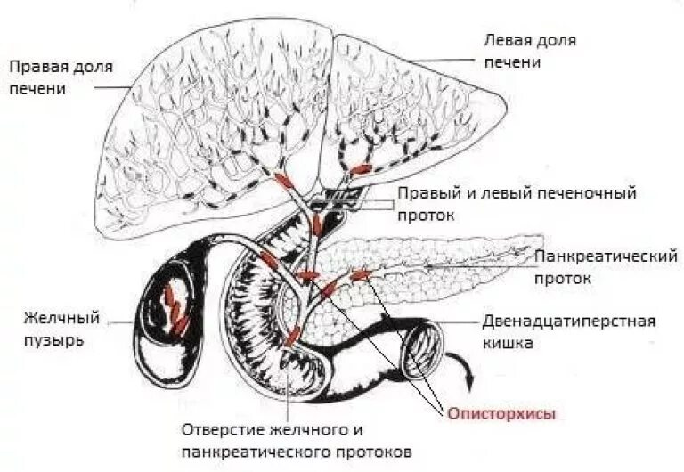 Описторхоз хроническая фаза. Описторхоз желчные протоки. Холангит желчного пузыря. Паразит лямблия у ребенка. Эхинококковая киста на узи.