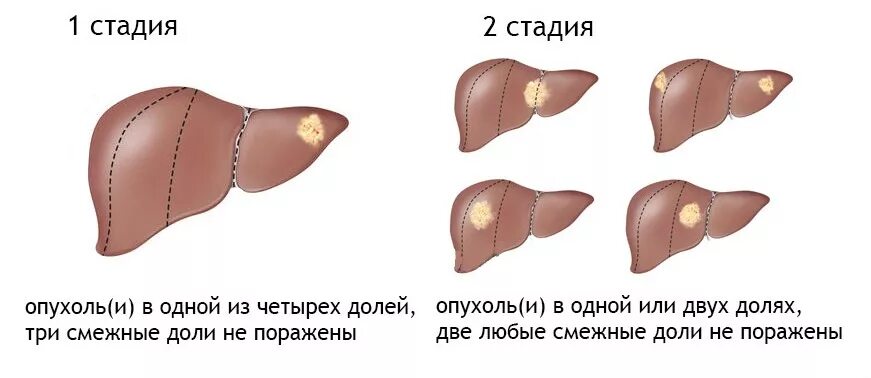 Рак печени 4 стадии сколько живут. Карцинома печени 2 стадии. Опухоль печени симптомы 2 стадии. Гепатоцеллюлярная карцинома печени. Онкология 2 степени печени.