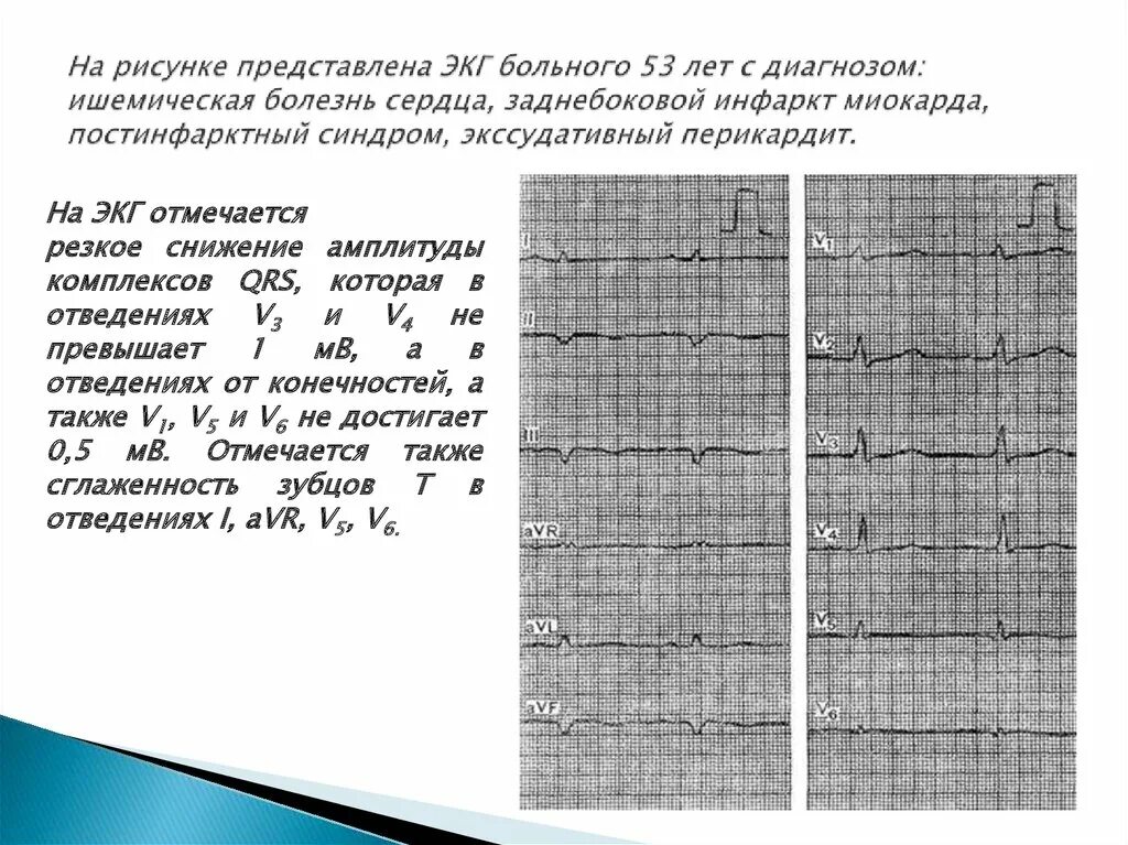 Изменение миокарда передне перегородочной области. Изменения на ЭКГ постинфарктный кардиосклероз. ЭКГ постинфарктный кардиосклероз заключение. ЭКГ пост ИНФАРКТНЫЙ кардио склкроз. ЭКГ постинфарктный кардиосклероз описание.