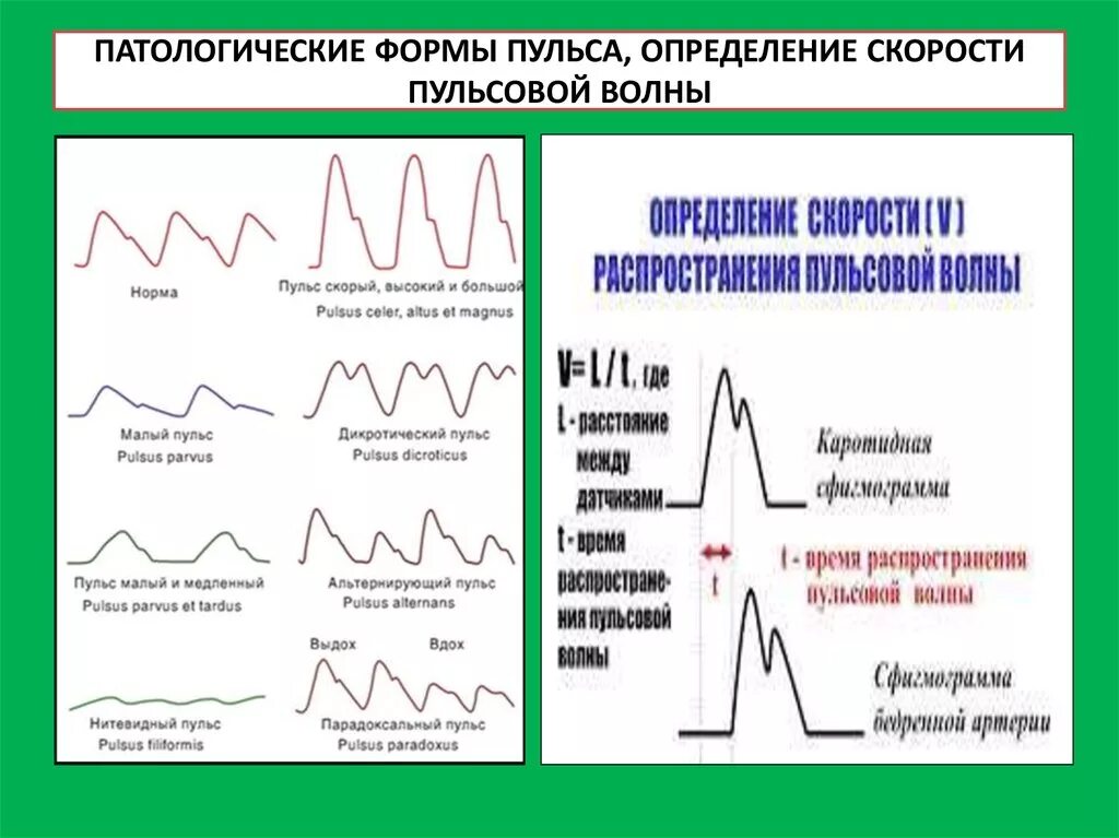 Пульсоксиметр график пульсовой волны. Форма пульсовой волны. Патологические формы пульсовой волны. Патологические формы пульса. Сильное наполнение пульса