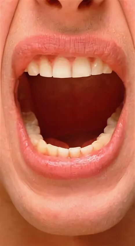 Как должен выглядеть рот. Серовато белый налет на языке. Как должен выглядеть рот. Как должен выглядеть рот. Серовато белый налет на языке.