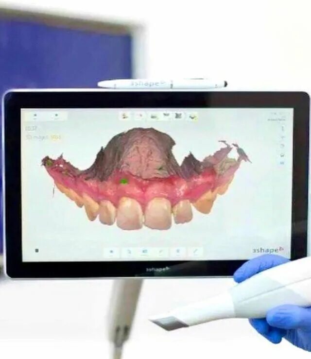 Сканер itero стоматология. Цифровой слепок челюсти. 3d технологии в стоматологии. Cad/cam интероральный сканер. Itero сканер.