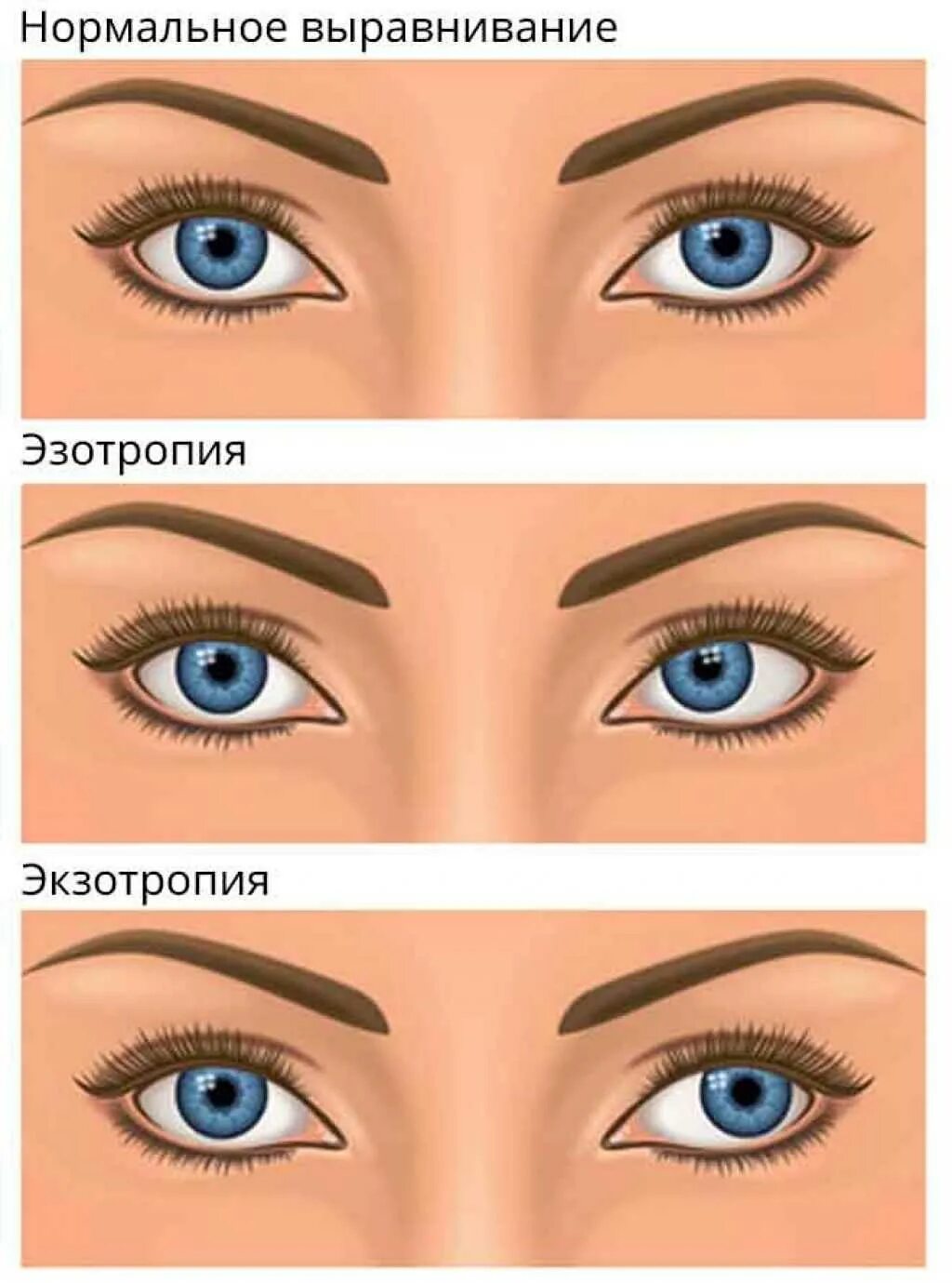 Косоглазие. Косоглазие экзотропия. Косоглазие схема. Эзотропия и экзотропия.