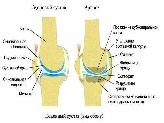 Нарушения коленного сустава. Остеоартроз синовиальная жидкость. Толщина суставного хряща коленного сустава. Толщина суставной щели коленного сустава в норме. Синовиальная жидкость при остеоартрозе.