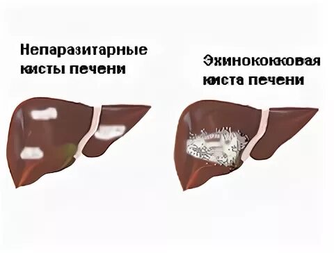 Кисты печени клинические рекомендации. Множественные непаразитарные кисты печени. Ретенционные кисты печени это. Истинные и ложные кисты печени.