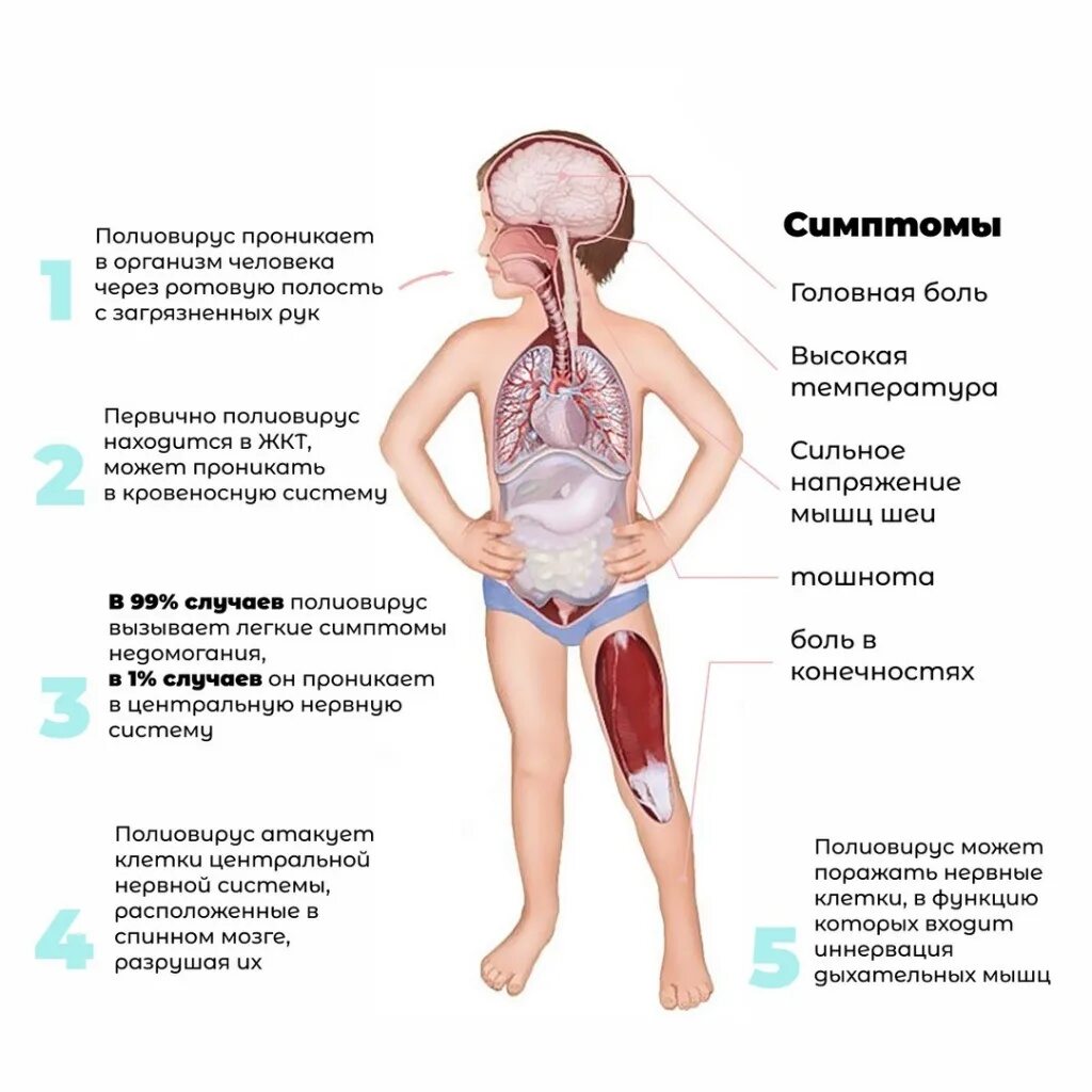 Паротит полиомиелит. Непаралитический полиомиелит. Полиомиелит симптоматика. Спинальная форма полиомиелита.