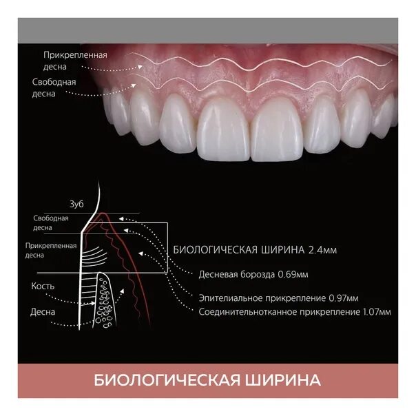 Схема десен. Биологическая ширина десны. Биологическая ширина в стоматологии. Биологическая ширина в области имплантатов. Биологическая ширина зуба.