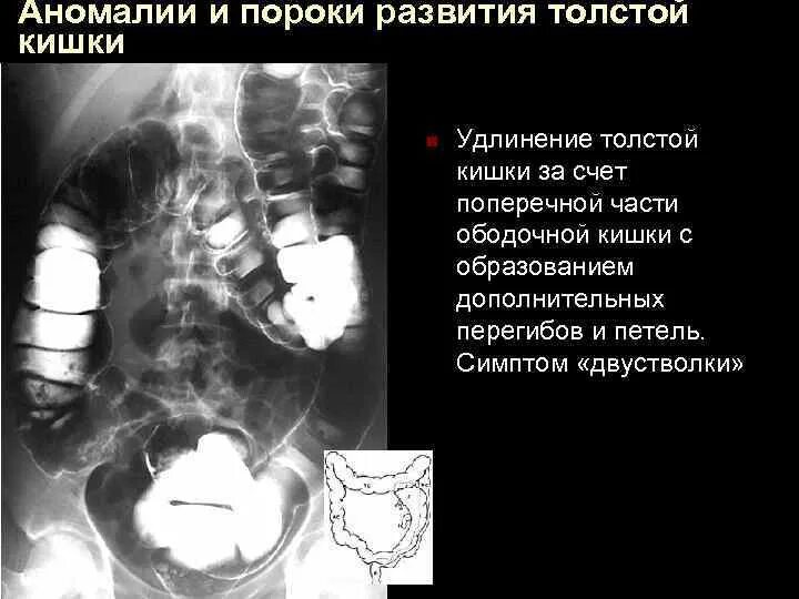 Дивертикул толстой кишки рентген. Толстая кишка анатомия долихосигма. Дивертикул кишечника рентген. Дивертикулы толстой кишки на рентгенограмме. Удлинена сигмовидной