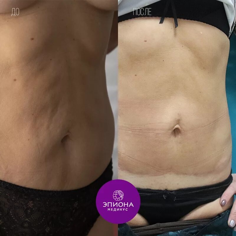 оперировать диастаз. абдоминопластика живота диастаз. абдоминопластика восстановительный период. абдоминопластика восстановительный период. диастаз и пупочная грыжа.