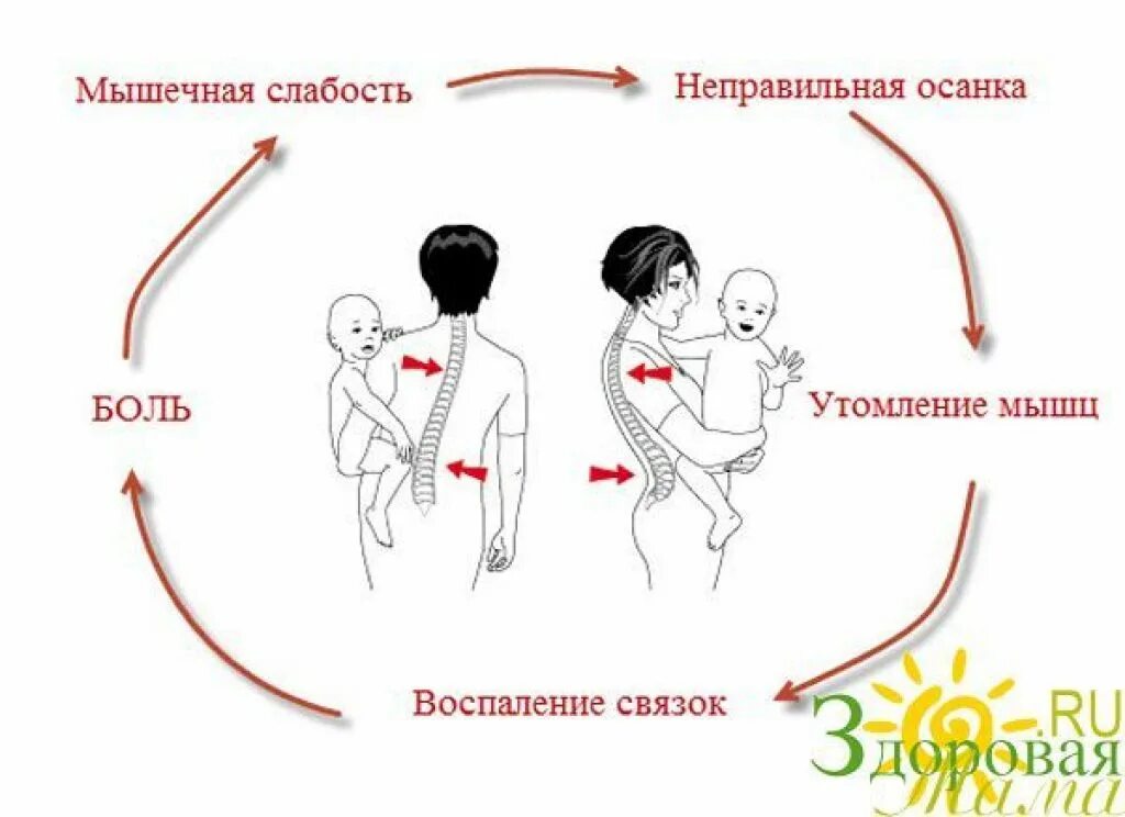 После беременности болит поясница. Болит спина после родов. После рождения ребенка болит спина. Боли в позвоночнике после родов. После родов болит поясница.