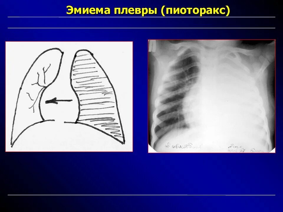 Эмпиема легкого. Гнойный плеврит (эмпиема). Парамедиастинальная эмпиема плевры. Бактериальная деструкция легких у детей.