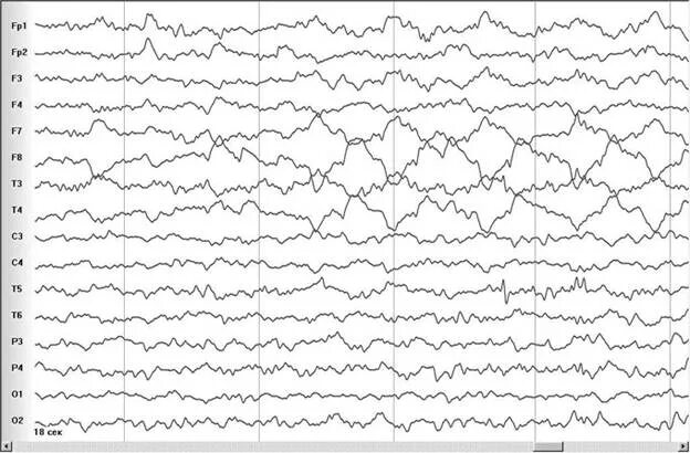 Низкоамплитудная ээг. ЭЭГ f7 f3 название. Альфа ритм ЭЭГ. ЭЭГ норма и патология. Энцефалограмма на бумаге.