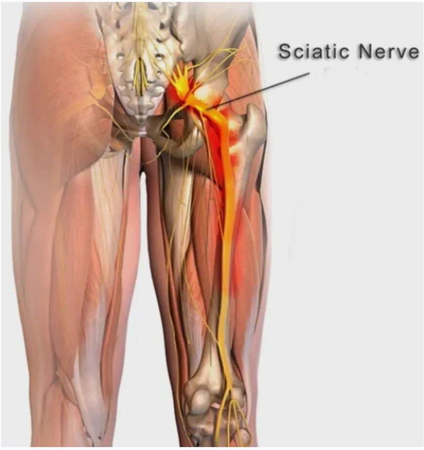 Мышца седалищного нерва. Седалищный нерв анатомия. Защемление седалищного нерва анатомия. Ход седалищного нерва анатомия.