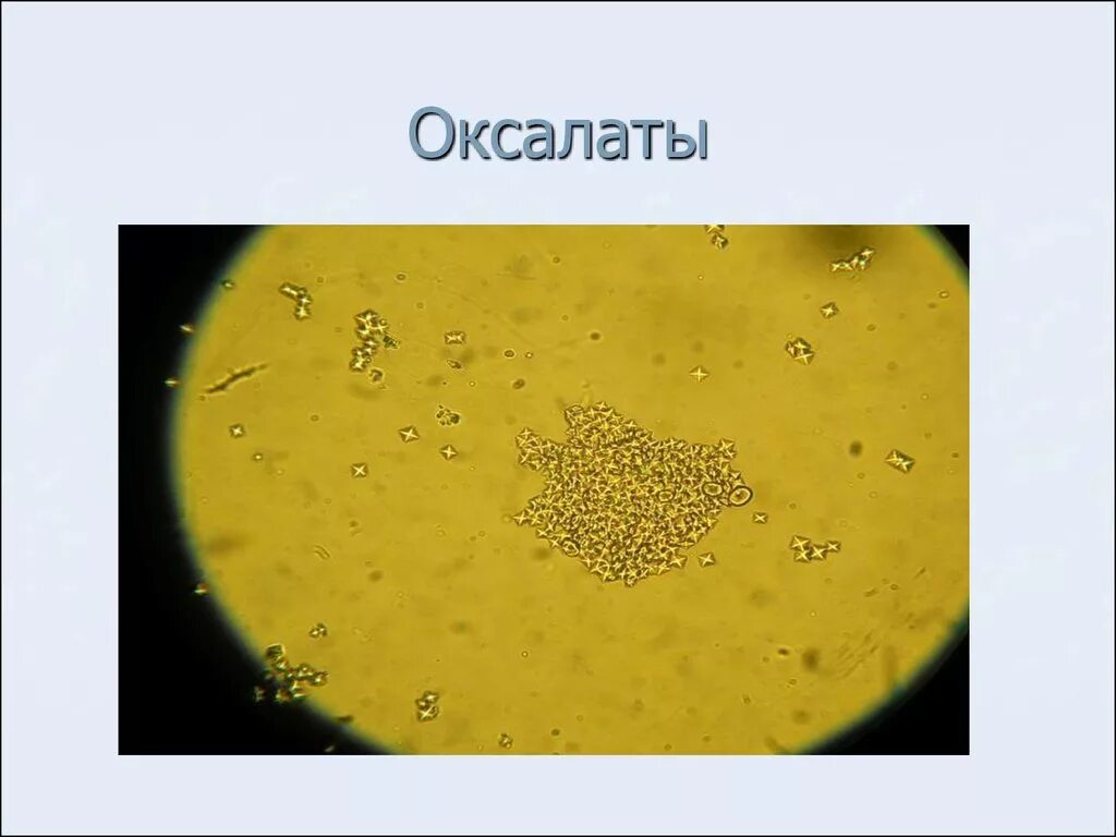 Высокая соль в моче. Оксалаты. Соли оксалаты. Оксалаты в моче. Соли Ураты в моче под микроскопом.