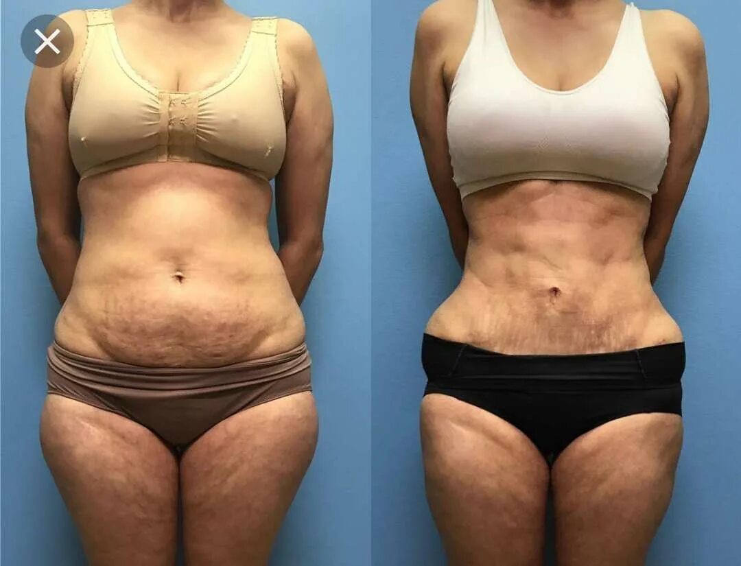 Пластическая хирургия липосакция. Операция жира. Операция жира. Операция жира. Операция жира.