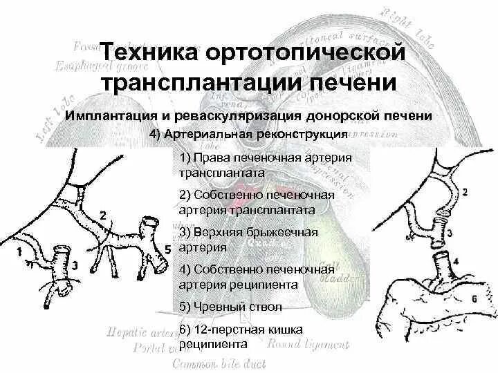 Классическая техника ортотопической трансплантации печени. Трансплантация печени этапы операции. Piggyback трансплантация печени. Трансплантация печени схема. Можно ли пересадить печень