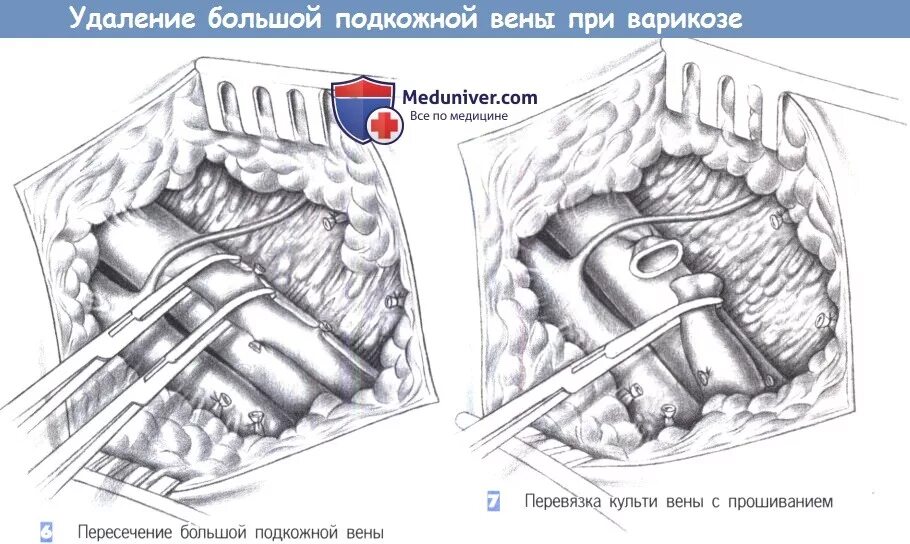 Удалить большую подкожную вену