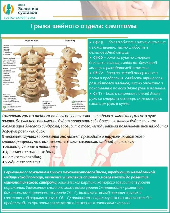 Как лечить шейную грыжу