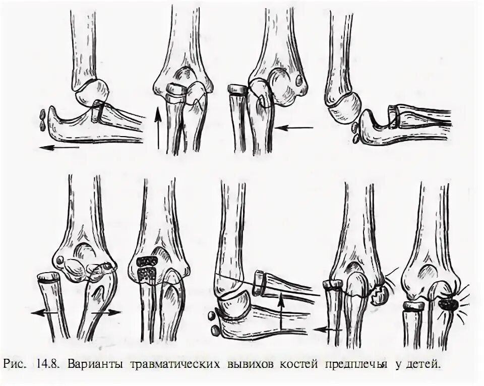 Подвывих локтевого сустава у ребенка