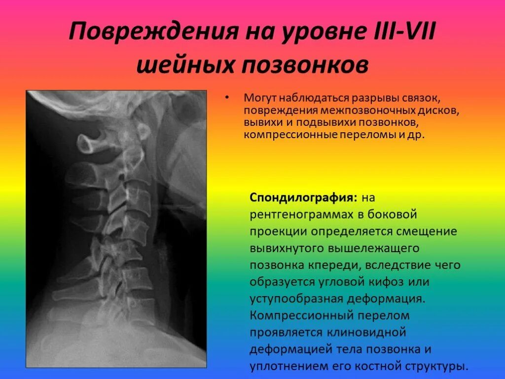 Шейный отдел позвоночника диагнозы. Смещение шейных позвонков рентген. Лестничное смещение шейных позвонков рентген. Смещение шейного позвонка рентген. Перелом шейных позвонков рентген.