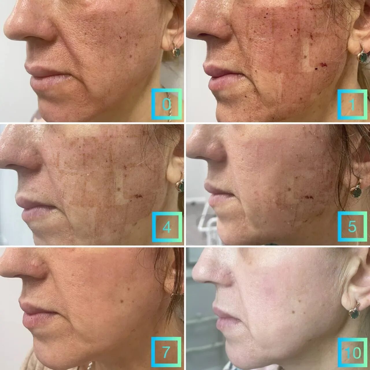 Лазерная шлифовка кожи цена skinlift ru. Лазерная шлифовка co2 Fraxel. Аппарат лазерной шлифовки fraxini co2. Лазерная шлифовка (со2 лазер). Лазерная шлифовка co2 Кандела.