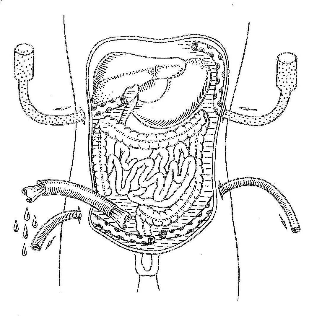 Что такое санация кишечника. Перитонеальный лаваж. Перитониальный лаважа. Лаваж брюшной полости. Перитонеальный лаваж при перитоните.