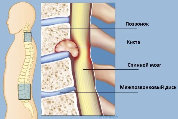 Болит поясница киста. Периневральная киста l1-l2. Киста на позвоночнике в поясничном отделе. Сужение костного позвоночного канала в поясничном отделе.