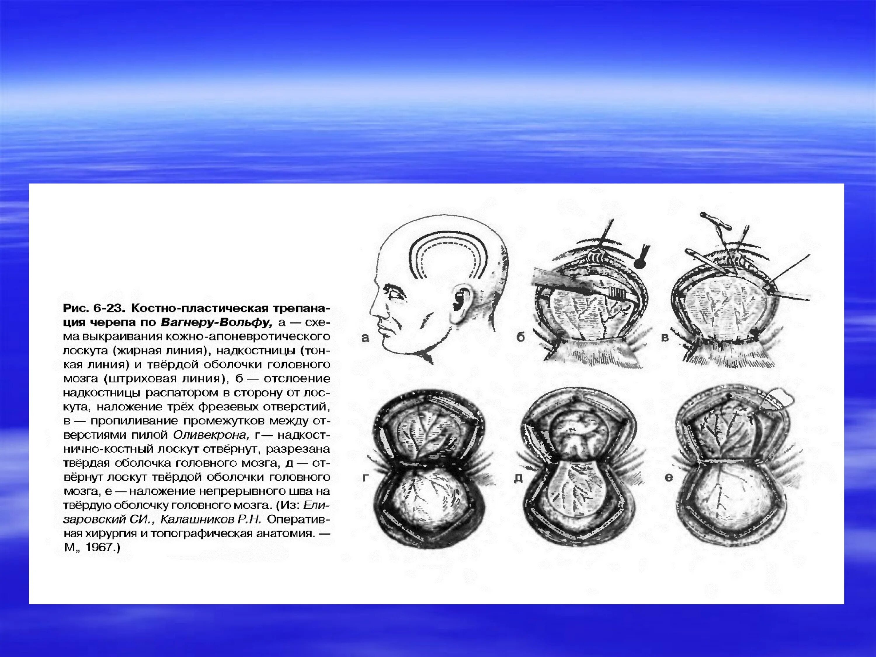 Костнопластическая Трепанация черепа по Вагнеру-Вольфу. Костно пластическая Трепанация черепа по Вагнеру Вольфу и Оливекрону. Костно-пластическая Трепанация по Вагнеру-Вольфу. Резекционная Трепанация черепа показания.