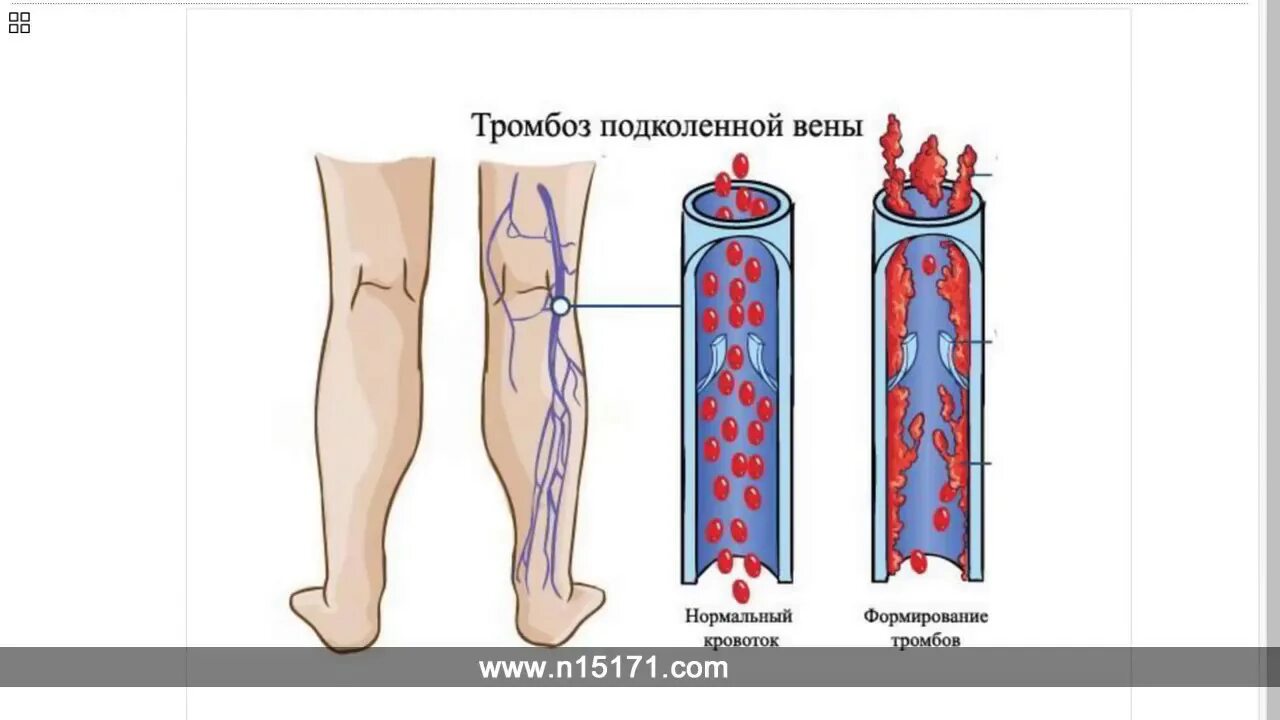 Тромбоз бпв. Тромбоз подколенной вены. Тромбофлебит подколенной вены. Тромб в подколенной Вене.