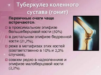 Туберкулез суставов лечение