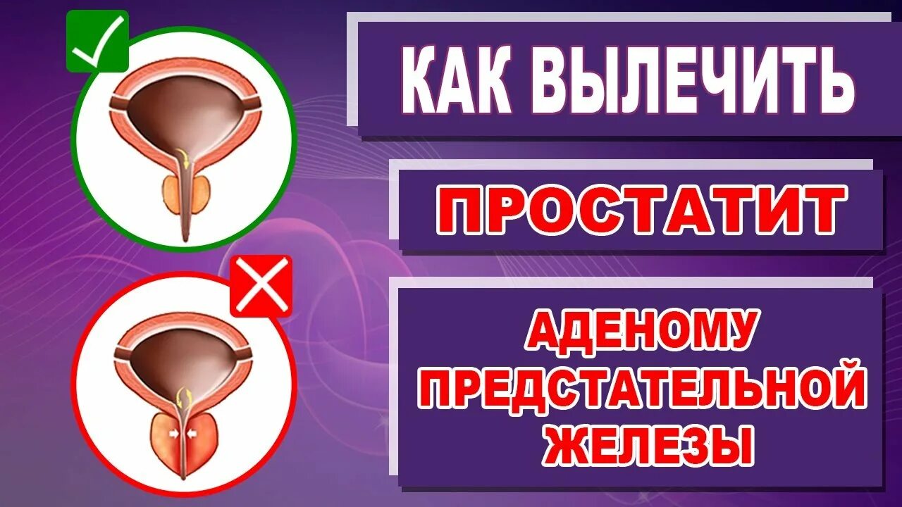 Хроническая простата аденома. Простатит, аденома предстательной железы. Предстательная железа аденома простаты. Аденома предстательной железы лекарства.