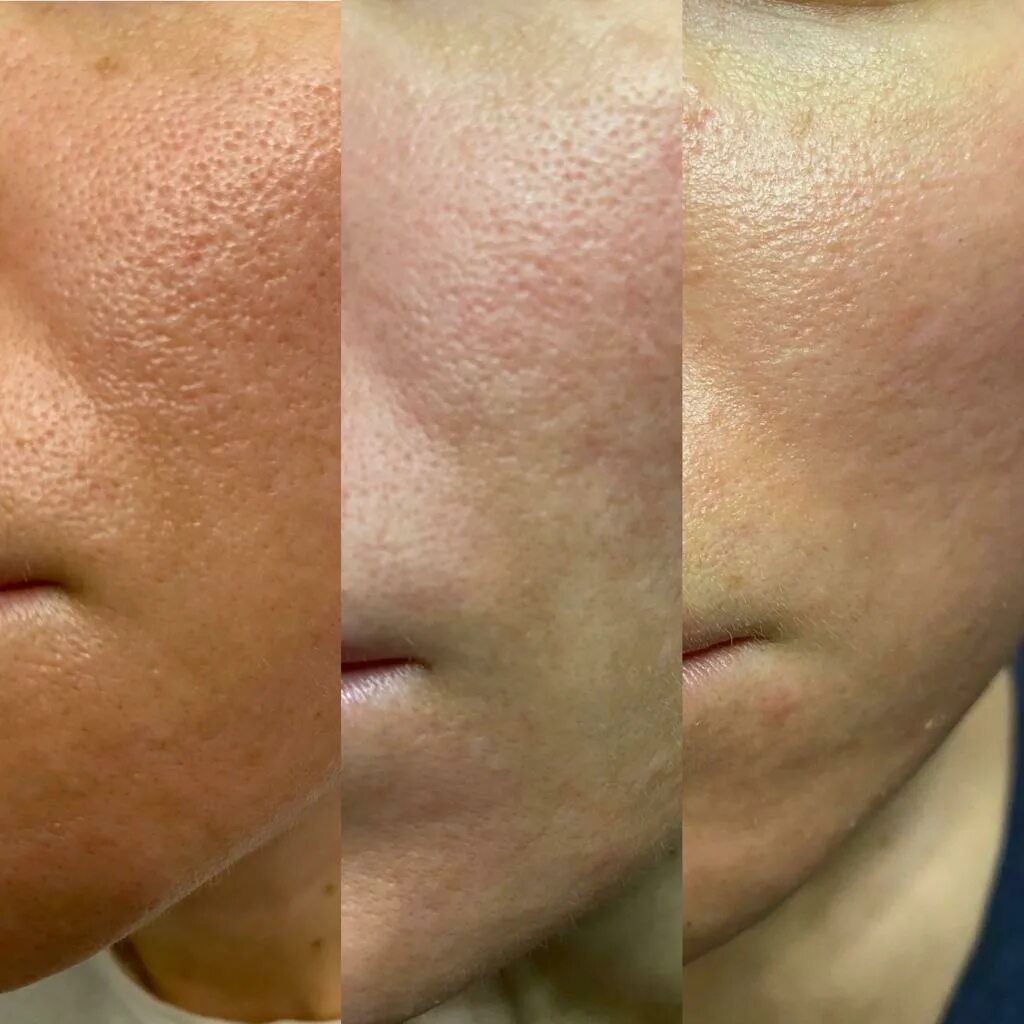 Лазерная шлифовка кожи цена skinlift ru. Лазерное омоложение co2 лица Comilfo. Фракционная лазерная шлифовка co2. Лазерная шлифовка Deka co2. Лазерная шлифовка co2 Сургут.