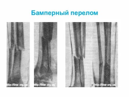 Механизм переломов костей